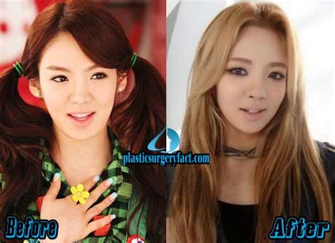 Hyoyeon Plastic Surgery Before And After Photos