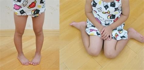 Pediatric Foot Disorders Healthy Feet Kw