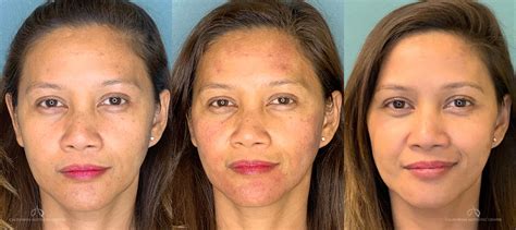 Ipl Photofacial Before And After Photos Dr Steve Vu