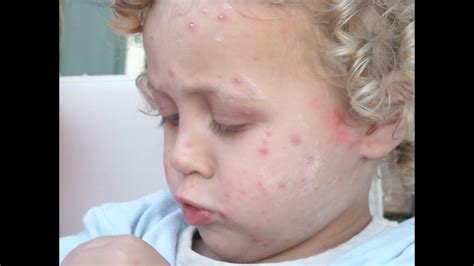 Herpes zoster epidemiology of herpes zoster. Shingles In Children, Signs Of Shingles, Herpes Zoster Symptoms, Disseminated Herpes Zoster ...