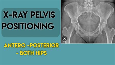 Xray Pelvis With Both Hips Pelvis X Ray Positioning Ap Pelvis X Ray