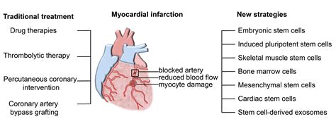 What Is Myocardial Infarction Vrogue Co