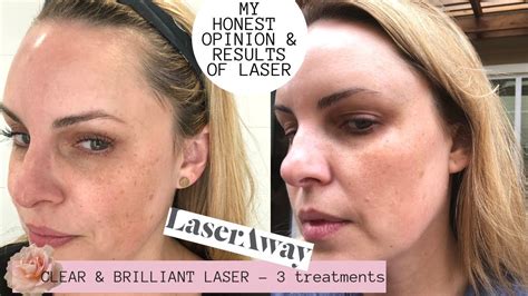 Laseraway Clear And Brilliant Laser Results Honest Review Pores Dark