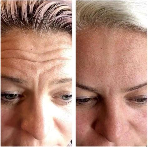 Wrinkles In Forehead Botox Before And After Pics 3 Facial