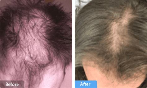 Fda Cleared Laser Cap To Regrow Hair After Hair Loss Kiierr Laser