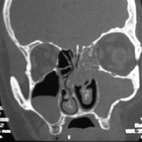 Coronal Ct Scan Of The Nose And Paranasal Sinuses Showed A Soft Tissue