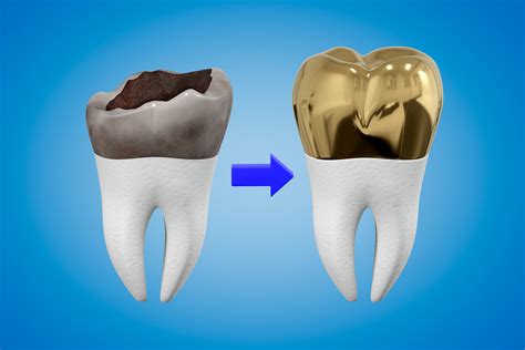 How To Find The Best Teeth Cap Price Prv Dental