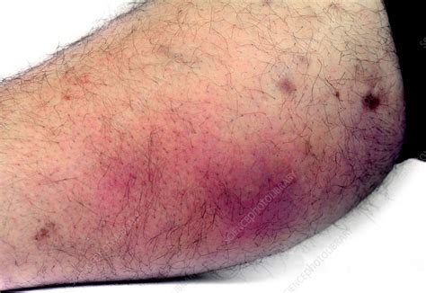 Cellulitis Stock Image C0197565 Science Photo Library