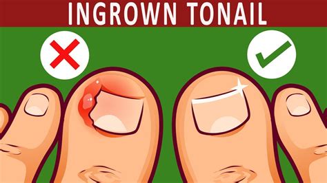 How To Get Rid Of Ingrown Toenail Naturally 10 Home Remedies Youtube