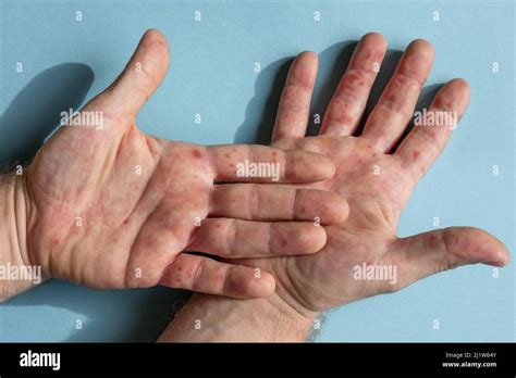 Painful Rash Red Spots Blisters On The Hand Close Up Allergy Rash Human Hands With Dermatitis
