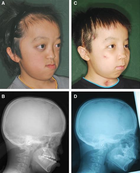 Crouzon Syndrome Before And After