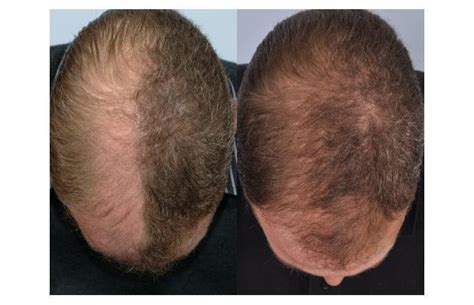 Unusual Cases Of Hair Loss Hrbr Ireland Hair Transplant Clinic Ireland