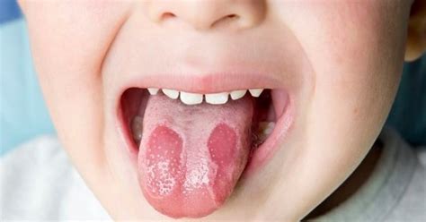 Zungenflecken Bei Kindern Und Säuglingen Was Bedeuten Die Weißen Und
