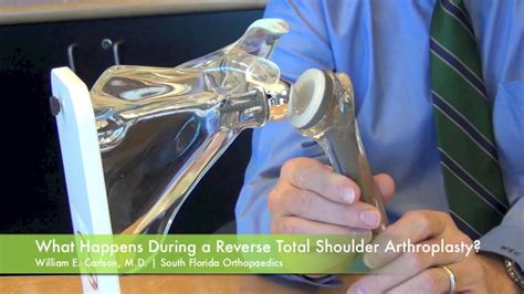 Reverse Total Shoulder Arthroplasty Surgery Dr William E Carlson