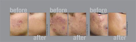 Fotona Twinlight™ Laser Acne And Acne Scars Treatment Toronto Pure