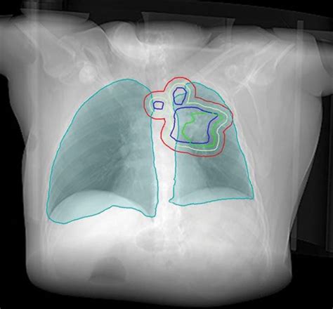 The Role Of Radiation Therapy In The Management Of Small Cell Lung