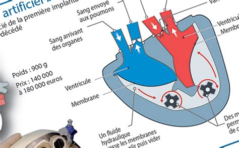 Infographie Carmat Comment Fonctionne Un Coeur Artificiel