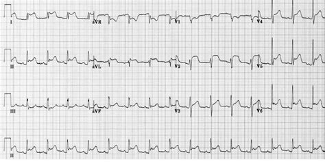 Se debe habitualmente a una infección viral. ISQUEMIA, LESION ,NECROSIS E INFARTO DE MIOCARDIO ...
