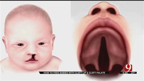 Medical Minute Cleft Palate
