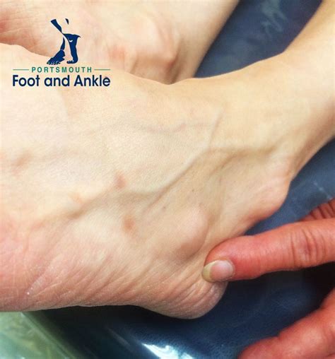 78 Images About Portsmouth Foot And Ankle Blogs On Pinterest Posts