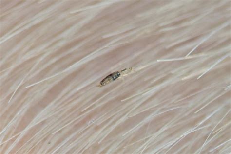 How To Identify Lice In Hair Dorado Ricated