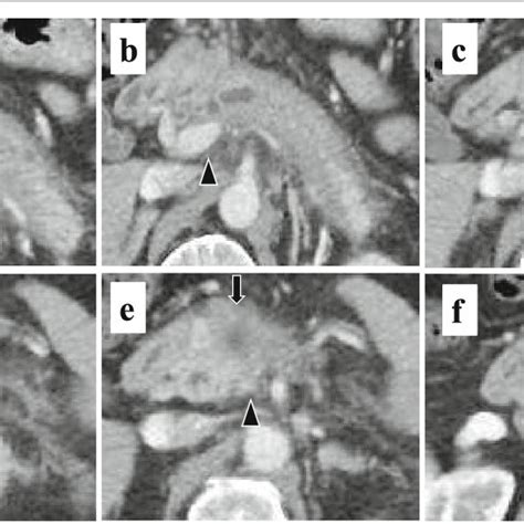 Abdominal Contrast Enhanced Computed Tomography Ct Showed Diffuse