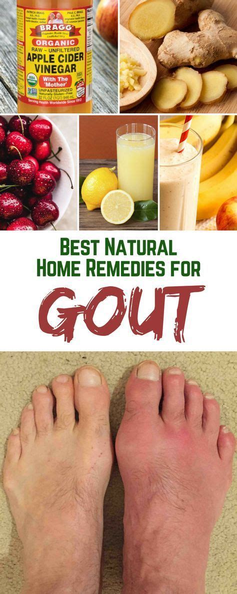 Best Natural Home Remedies For Gout Gout Gout Remedies Home