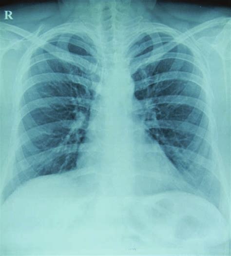 Chest X Ray Pa View Showing Normal Lung Fields Pa Posteroanterior