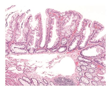 Representative Histology With H E Staining Of A A Sessile Serrated