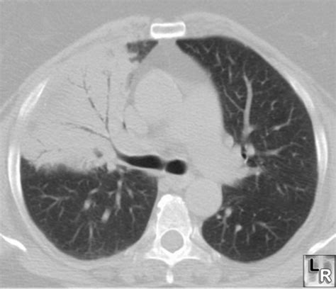 Radiology Pregnancy Infection And Treatment Chest Radiology 51 93