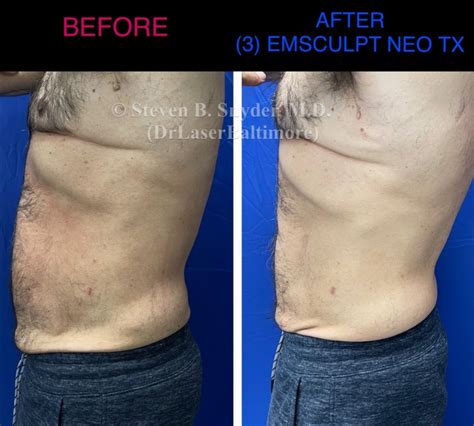 Emsculpt Neo Before And After Gallery Dermatology Laser Center And Medispa
