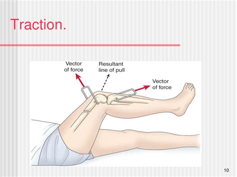 What care should the nurse provide for this patient? PPT - Chapter 67 Musculoskeletal Care Modalities ...