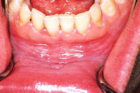 White Gums Causes Symptoms And How To Get Rid Of Them