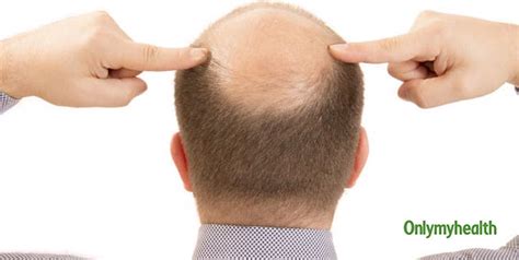 Baldness Causes And Treatments Justinboey