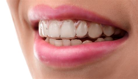 Somit sind sie beim essen als auch bei der täglichen mundhygiene absolut unbedenklich. Thieler Orthodontics | Braces | Invisalign| Houma, LA