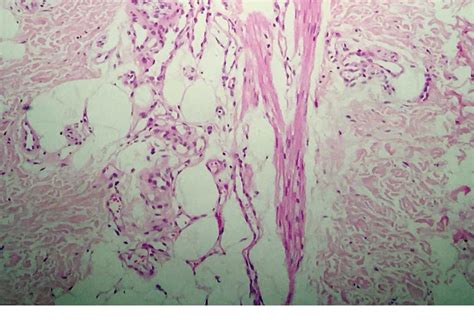 Verrucous Hemangioma And Histopathological Differential Diagnosis With
