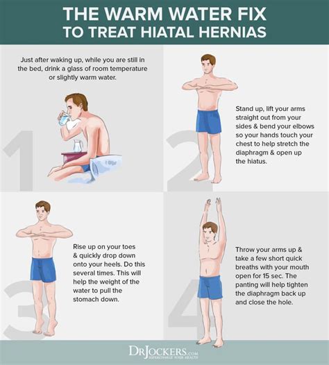 Hiatal Hernia Symptoms Causes And Natural Support Strategies Hernia