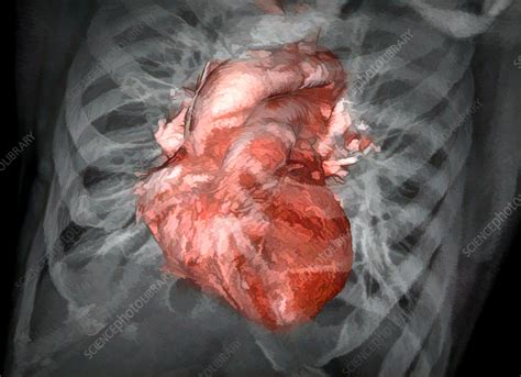 Healthy Heart Ct Scan Stock Image C0577920 Science Photo Library
