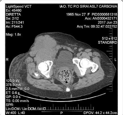 Case 2 Axial Computed Tomography Scan Showing The Lymph Node Mass 14