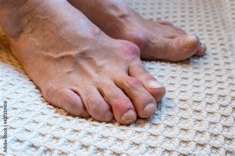 Deformed Big Toe With A Protruding Bone Rheumatoid Arthritis Or Gout