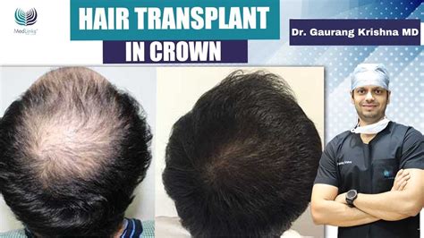 Hair Transplant In Crown Area Best Crown Area Hair Transplant
