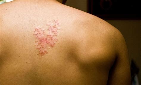 What Is Shingles Everything You Need To Spot And Treat This Condition