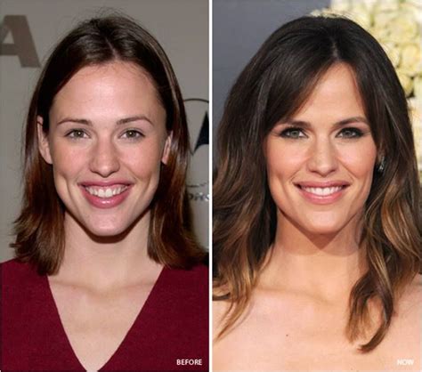 Jennifer Garner Paints The Perfect Picture Of How Botox Can Be Used To