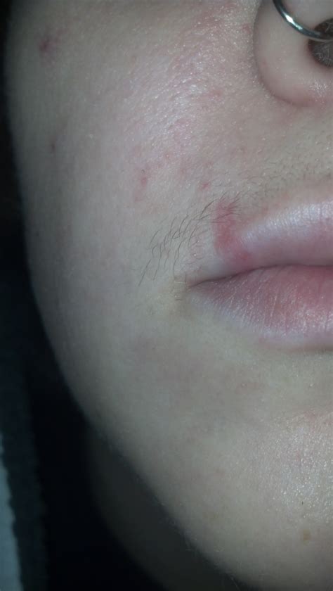 I Woke Up This Morning With A Rash Above My Lip With Redness