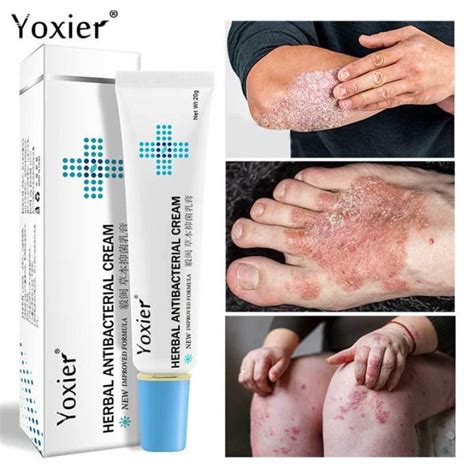 Factory Direct Sales Yoxier Herbal Antibacterial Cream Eczema Cream