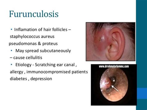 external ear cellulitis