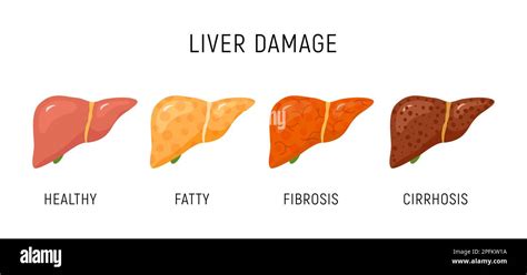 Liver Damage Infographic Diagram Cancer Disease Anatomy Liver Damage