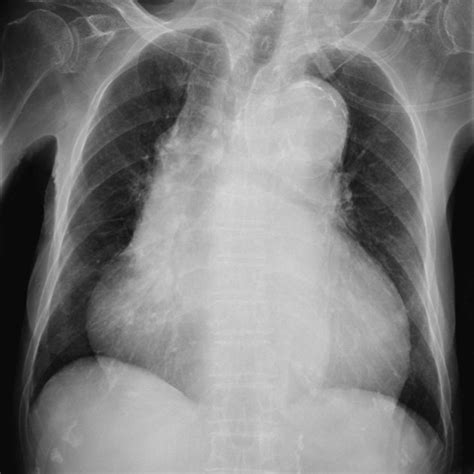 The Chest X Ray Shows A Widened Mediastinum And Cardiomegaly