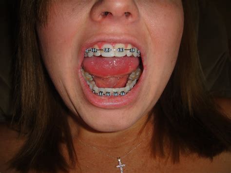 We did not find results for: Getting Braces
