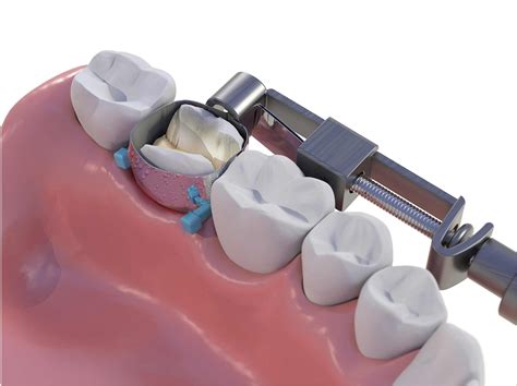 Pinkband Dental Solutions Matrix Band Dentistry Today